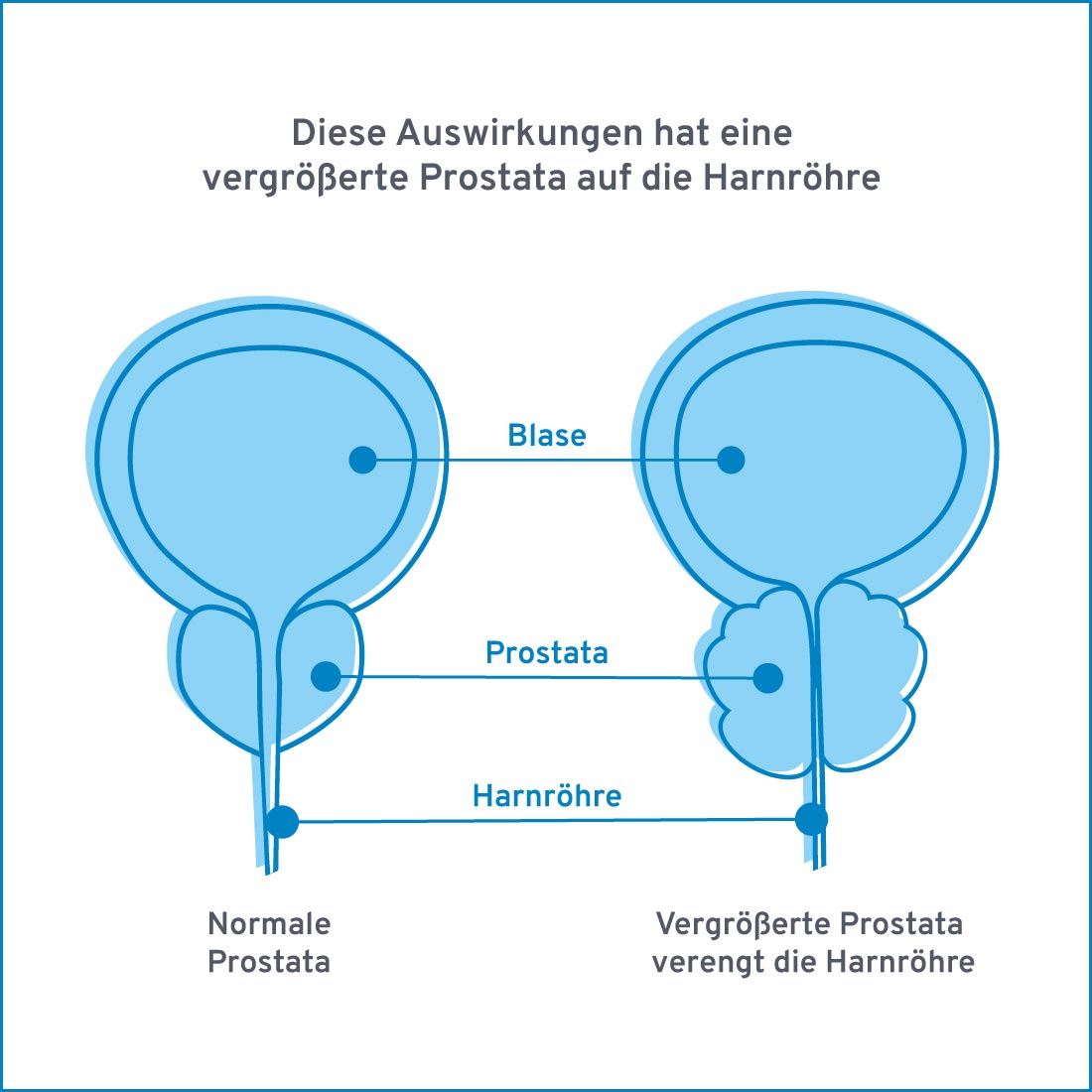 Prostatavergrößerung Düsseldorf
